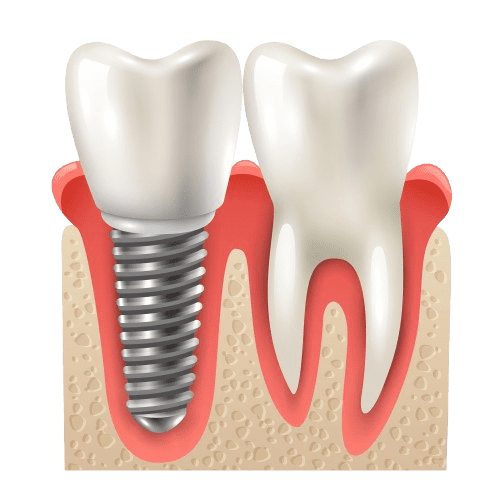 dental implants cost rs puram Coimbatore service at Boss Dental clinic in Coimbatore