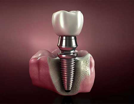 dental implants cost rs puram Coimbatore service at Boss Dental clinic in Coimbatore