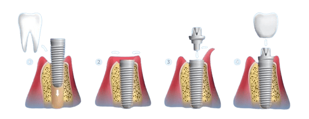 dental implants cost rs puram Coimbatore service at Boss Dental clinic in Coimbatore