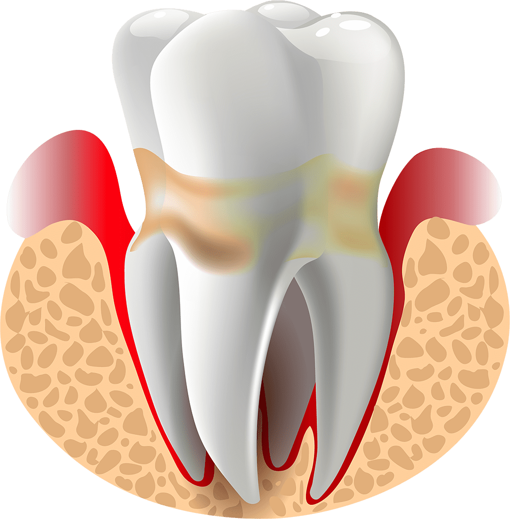 gum disease treatment service at Boss Dental clinic in Coimbatore