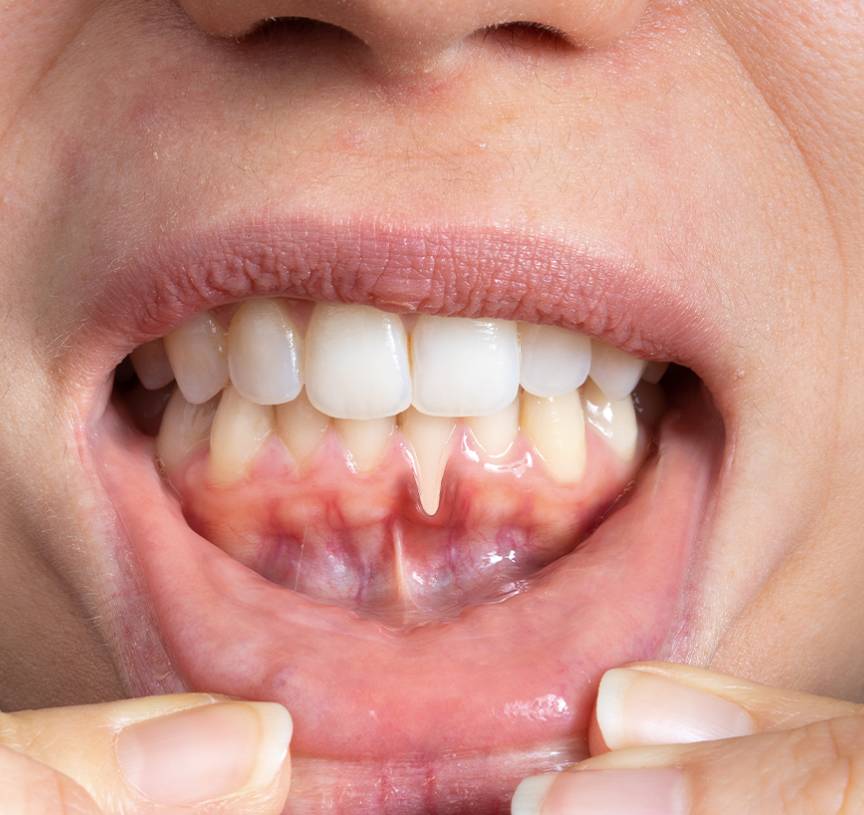 gum disease treatment service at Boss Dental clinic in Coimbatore