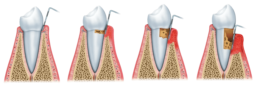 dental fillings service at Boss Dental clinic in Coimbatore