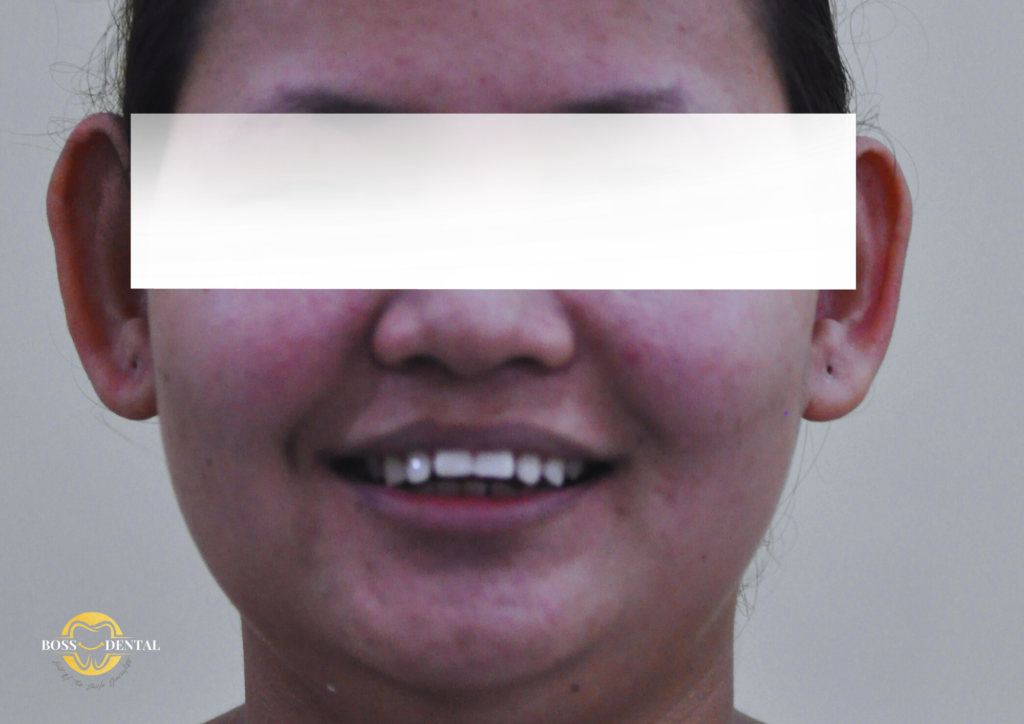Before